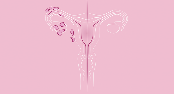 medpex-blog-endometriose
